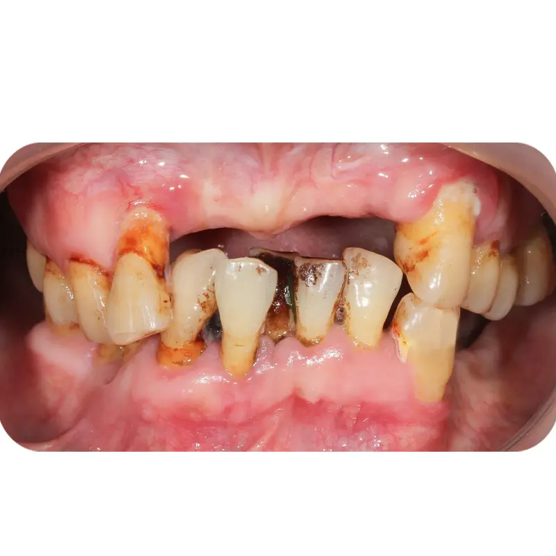 khach hang cay implant tai shark dental 2