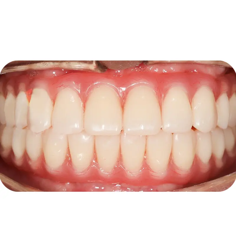 khach hang cay implant tai shark dental 3