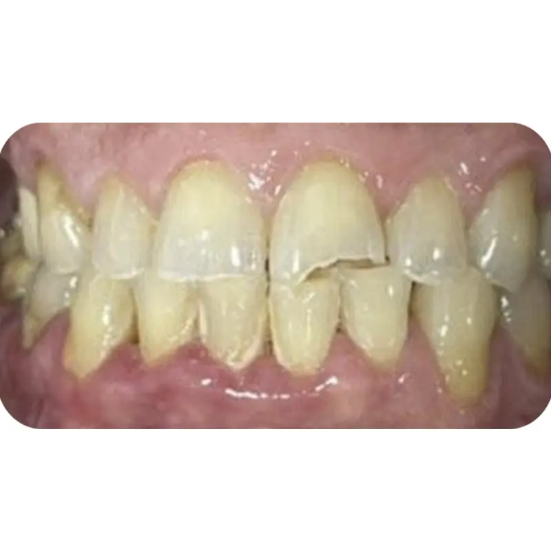khach hang da su veneer 2