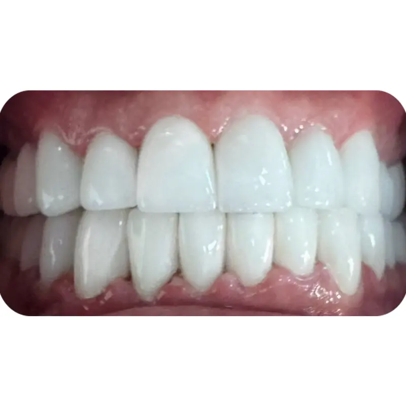 khach hang da su veneer 3