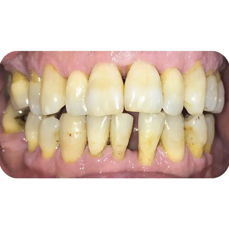 khach nuoc ngoai dan su veneer 2