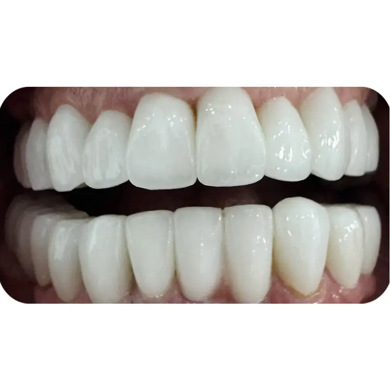 khach nuoc ngoai dan su veneer 3