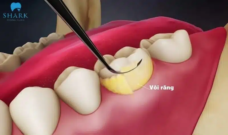7 cách lấy cao răng lâu năm tại nhà hiệu quả và dễ thực hiện 8 Loại bỏ cao răng nhằm tránh được những nguy cơ gây hại cho sức khỏe răng miệng