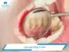 7 cách lấy cao răng lâu năm tại nhà hiệu quả và dễ thực hiện