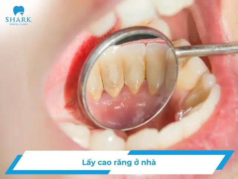 Lấy cao răng ở nhà