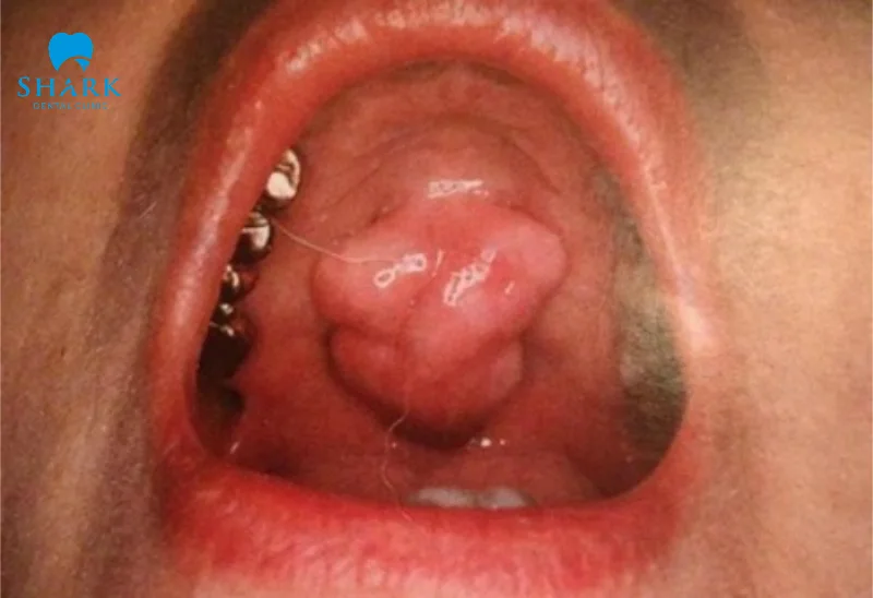 Lồi củ xương hàm