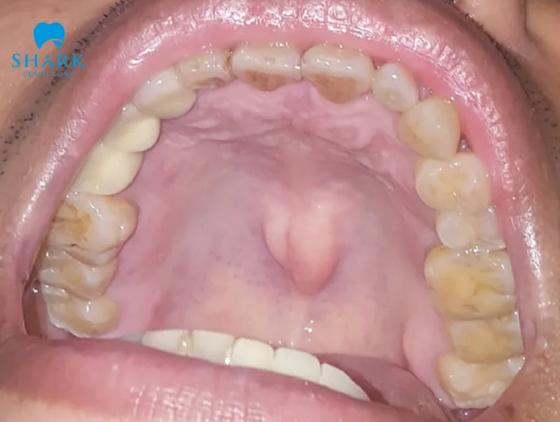 Yếu tố di truyền ảnh hưởng lớn nhất đến tình trạng lồi của xương hàm trên