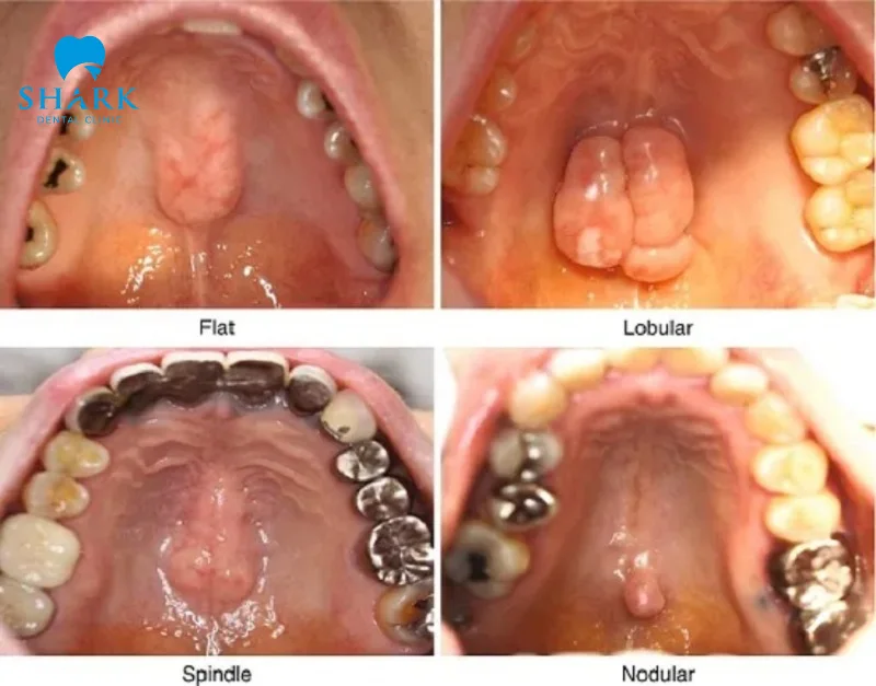 Các loại torus xương hàm trên