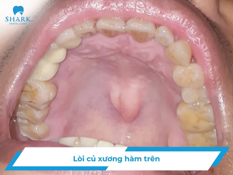 Lồi củ xương hàm trên