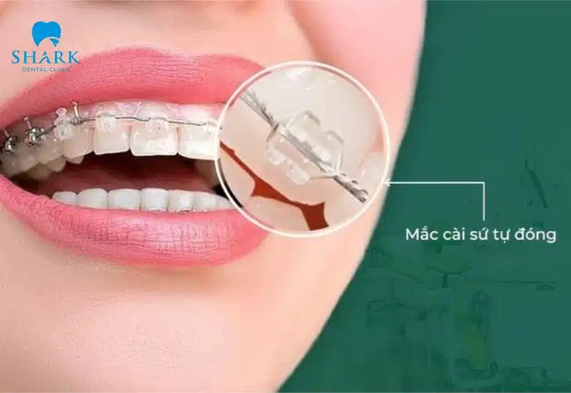Niềng răng mắc cài sứ tự buộc là gì? Giá bao nhiêu tiền? 11 Self-ligating ceramic braces