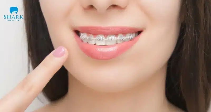 Niềng răng mắc cài sứ tự buộc là gì? Giá bao nhiêu tiền? 18 Chú ý làm sạch răng miệng đúng cách để tăng hiệu quả chỉnh nha