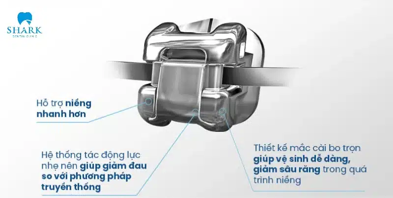 Niềng răng mắc cài kim loại tự buộc là gì? Giá bao nhiêu tiền? 13 Mắc cài tự động sẽ giúp giảm thời gian điều trị so với mắc cài thường