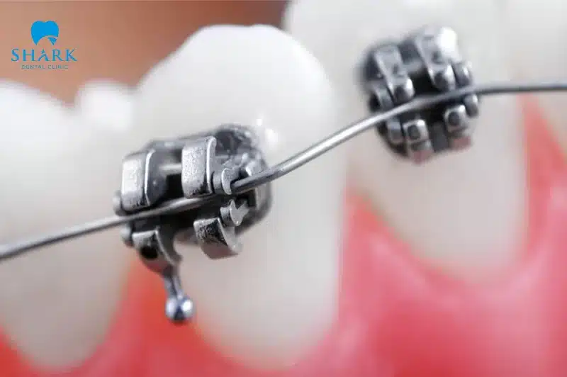 Niềng răng mắc cài kim loại tự buộc là gì? Giá bao nhiêu tiền? 20 Mắc cài kim loại tự động