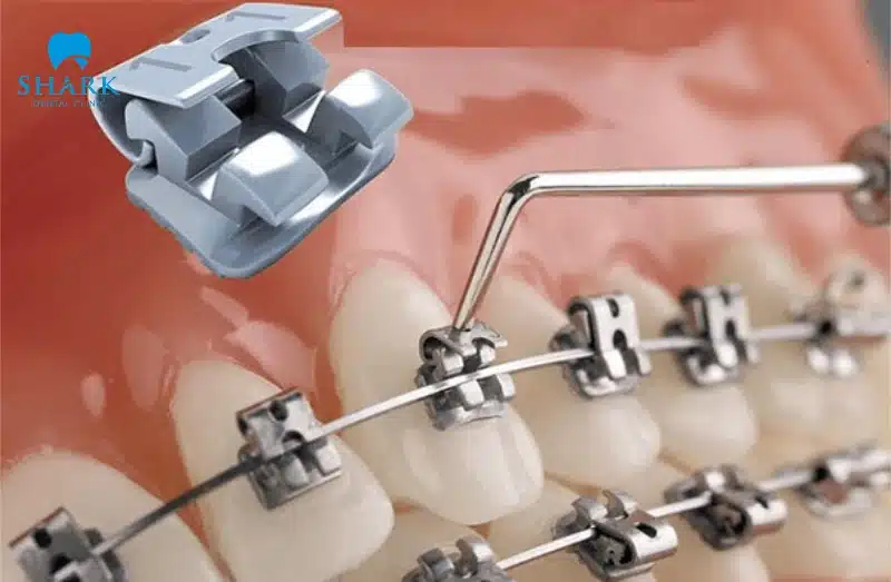 Niềng răng mắc cài kim loại