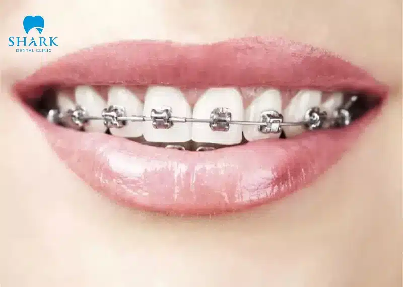 Niềng răng mắc cài kim loại tự buộc là gì? Giá bao nhiêu tiền? 15 Niềng răng mắc cài kim loại tự buộc phù hợp với nhiều tình trạng sai lệch khớp cắn khác nhau