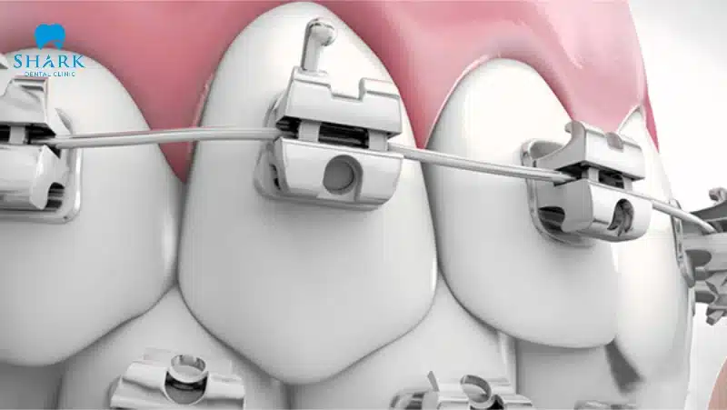 Niềng răng mắc cài kim loại tự buộc là gì? Giá bao nhiêu tiền? 21 Đeo niềng răng mắc cài tự động có thể rút ngắn thời gian niềng hơn so với mắc cài truyền thống
