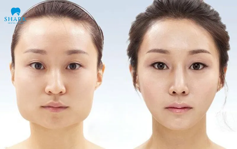 Phẫu thuật gọn hàm cho khuôn mặt vuông