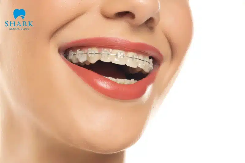 Mặt kim cương: Đặc điểm và ý nghĩa tướng số tốt hay xấu 26 Niềng răng không phải là phương pháp tạo hình dáng mặt kim cương hiệu quả