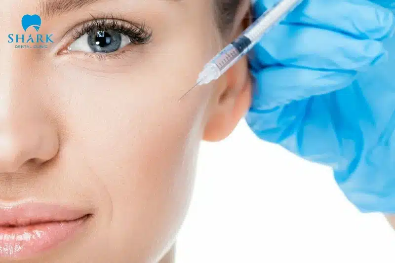 Tiêm filler làm đầy gò má tạo nên dáng mặt hình tim