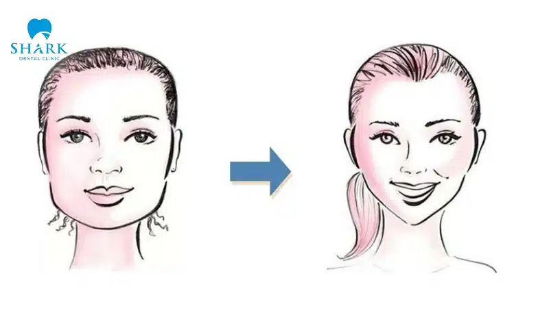 Niềng răng có thể thay đổi dáng mặt dựa vào việc thay đổi khung hàm