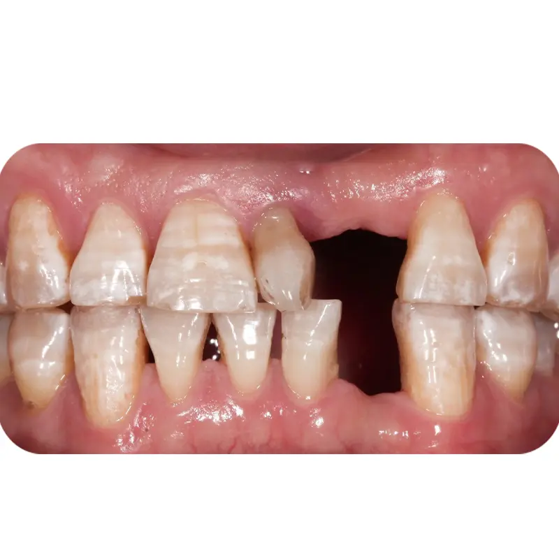 mr dung had full jaw dental implants 1