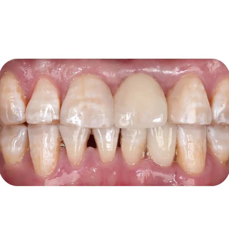 mr dung had full jaw dental implants 2