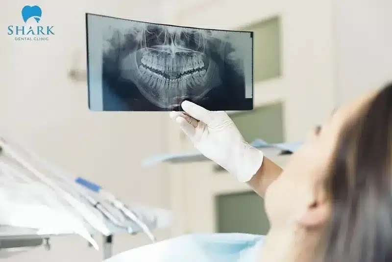 Kết quả chụp X-quang sẽ giúp bác sĩ chẩn đoán và lên kế hoạch nhổ răng một cách chính xác