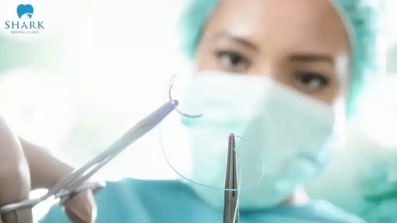 Sau khi răng khôn được loại bỏ, khách hàng được cầm máu và khâu vết thương