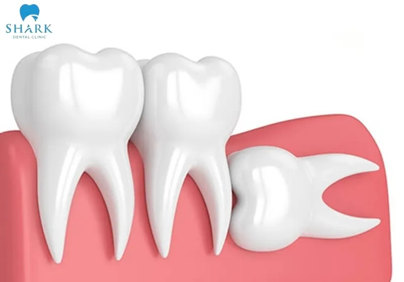 Bác sĩ giải đáp: Nhổ răng khôn bao lâu thì hết chảy máu? 7 Nhổ răng khôn mọc ngang hoặc mọc ngầm, thời gian cầm máu có thể sẽ lâu hơn