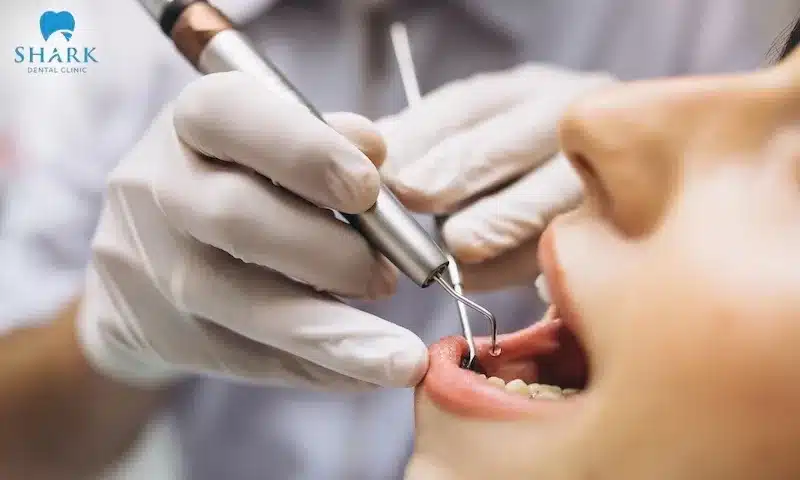Bác sĩ giải đáp: Nhổ răng khôn bao lâu thì hết chảy máu? 8 Nhổ răng khôn bao lâu thì hết chảy máu cũng một phần phụ thuộc vào kỹ thuật thực hiện của bác sĩ
