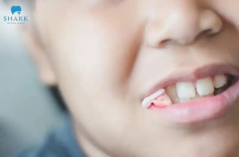 Bác sĩ giải đáp: Nhổ răng khôn bao lâu thì hết chảy máu? 9 Thời gian cầm máu sau khi nhổ răng khôn thường kéo dài 30 - 60 phút, đôi khi cũng lâu hơn từ 1 - 2 tiếng
