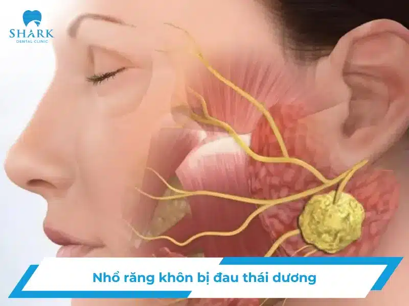 Nhổ răng khôn bị đau thái dương