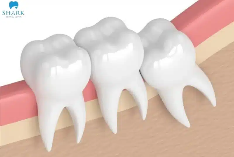 Mọc răng khôn cũng là một trong những nguyên nhân hàng đầu trong danh sách nhức răng gây đau nửa đầu