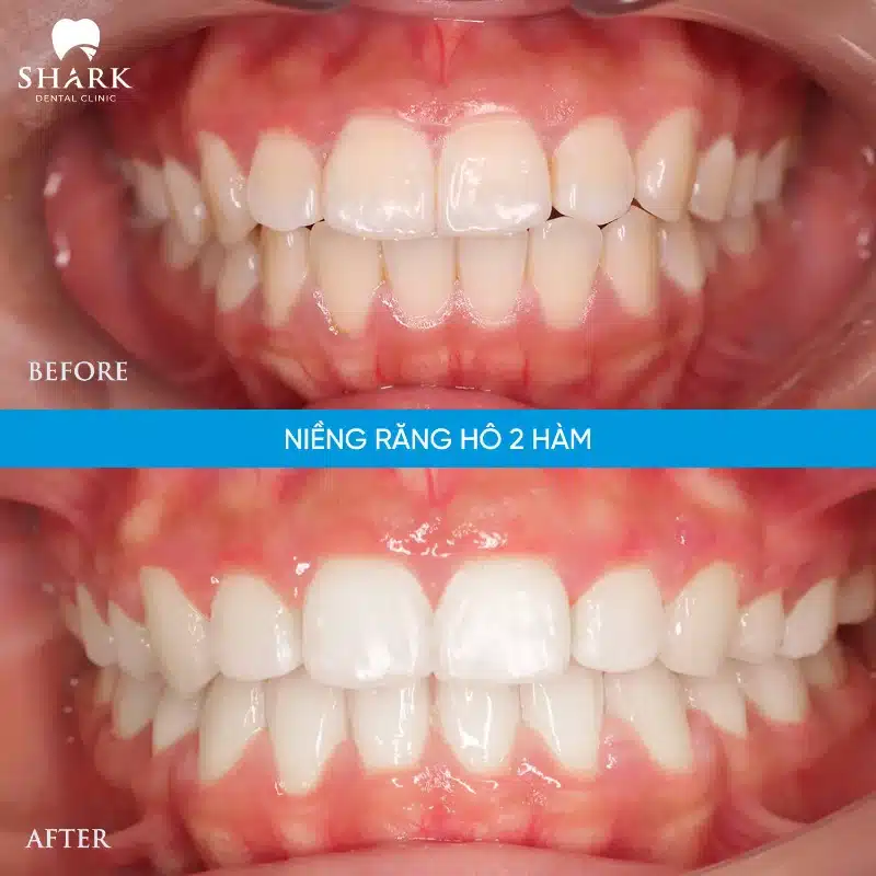 Niềng răng hô: Quy trình và giá niềng răng hô là bao nhiêu? 20 Niềng răng hô 2 hàm