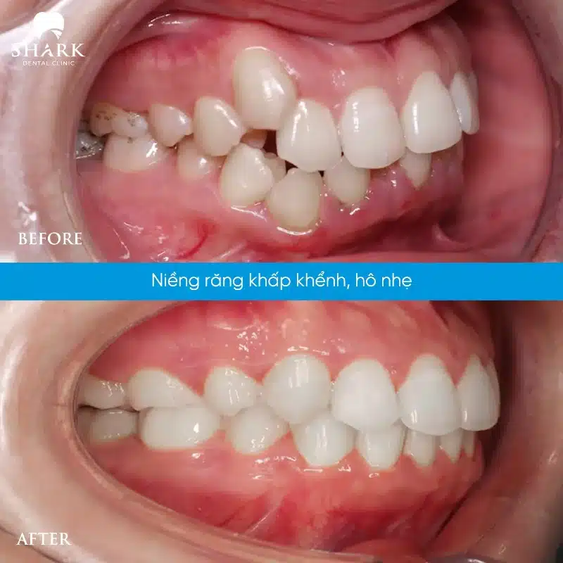 Niềng răng hô: Quy trình và giá niềng răng hô là bao nhiêu? 21 Răng hô khấp khểnh