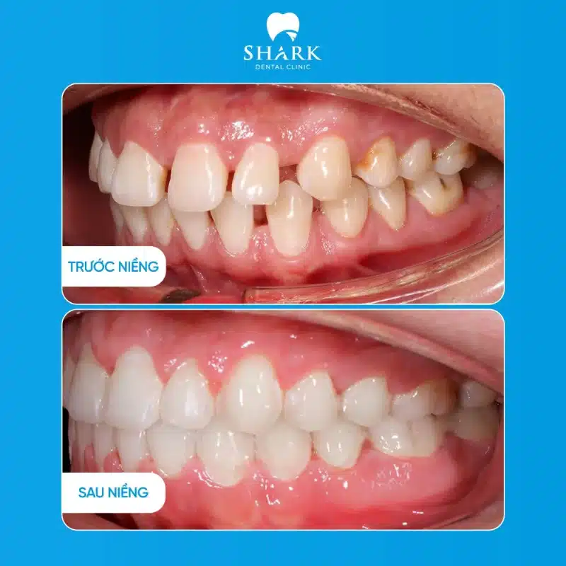 Niềng răng hô: Quy trình và giá niềng răng hô là bao nhiêu? 22 Niềng răng cải thiện tình trạng hô