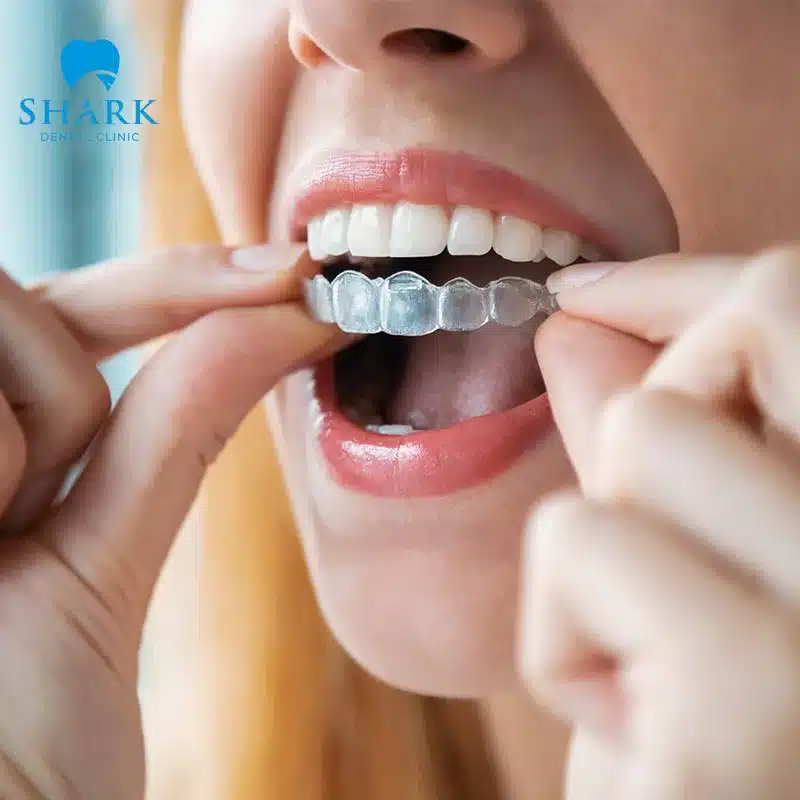 Niềng răng trong suốt Invisalign là gì? Có ưu điểm gì? 13 Quá trình siết răng êm ái, ít khó chịu