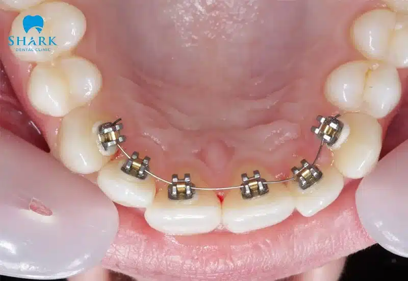 Niềng răng mặt trong là gì? Giá niềng mặt lưỡi bao nhiêu? 12 Giá niềng mặt lưỡi sẽ cao hơn mặt ngoài vì yêu cầu kỹ thuật cao