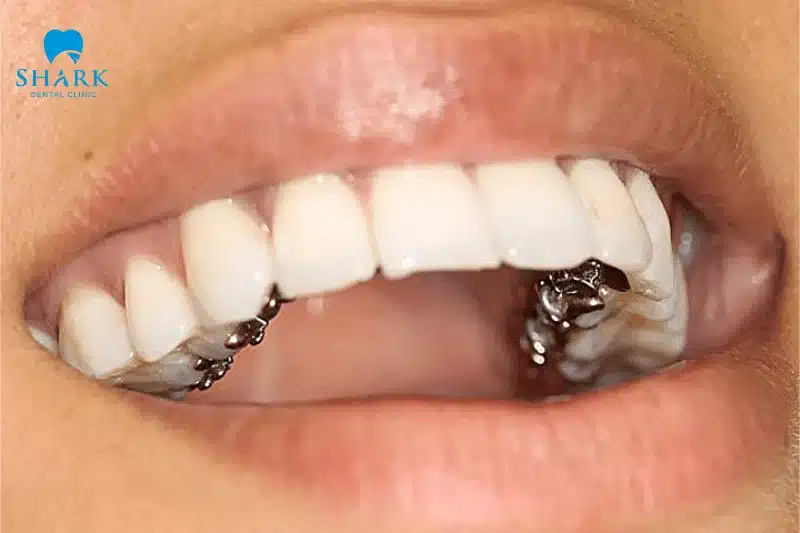 Niềng răng mặt trong là gì? Giá niềng mặt lưỡi bao nhiêu? 13 Niềng răng mặt trong đúng quy trình chuẩn sẽ mang lại hiệu quả cao và tính thẩm mỹ toàn vẹn