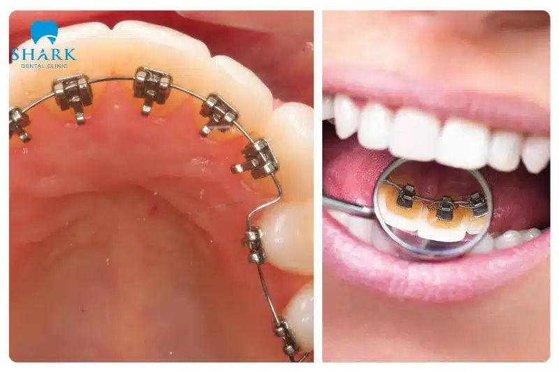 Niềng răng mặt trong là gì? Giá niềng mặt lưỡi bao nhiêu? 14 Bạn hãy đến tái khám định kỳ để kiểm tra mắc cài