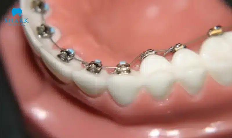 Niềng răng mặt trong là gì? Giá niềng mặt lưỡi bao nhiêu? 15 Niềng răng mặt trong có giá tình nhỉnh hơn truyền thống nhưng vẫn là phương pháp tiết kiệm chi phí so với khay trong suốt