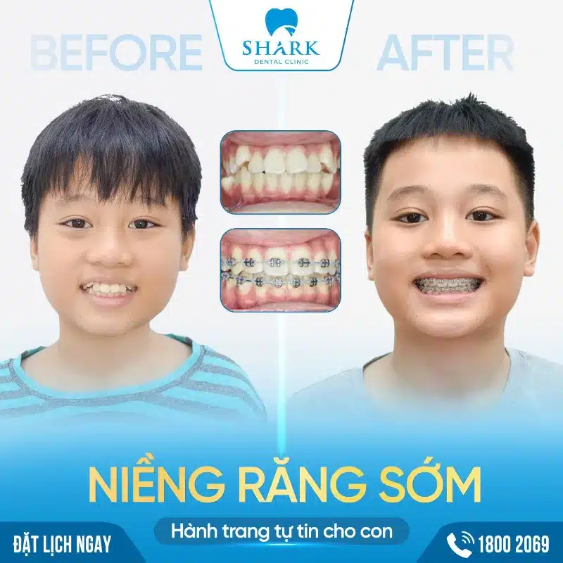 Niềng răng ốc nong rộng là gì? Có những lợi ích như thế nào? 14 Trọn gói nong hàm và chỉnh nha ở Shark