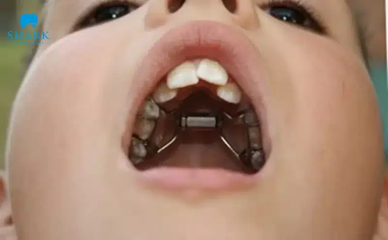 Niềng răng ốc nong rộng là gì? Có những lợi ích như thế nào? 10 Nong hàm trong niềng răng
