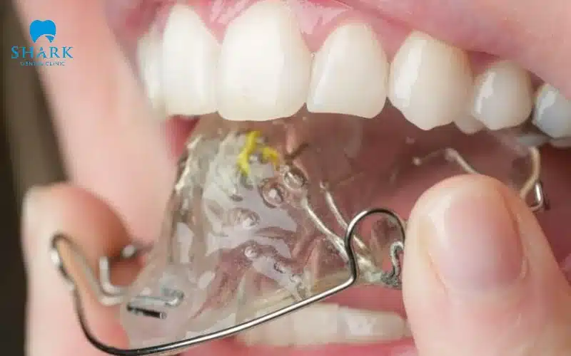Niềng răng ốc nong rộng là gì? Có những lợi ích như thế nào? 13 Nếu nong bằng hàm Hawley có thể tháo ra để vệ sinh dễ dàng