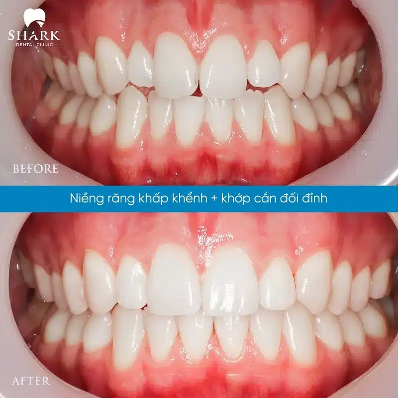 Niềng răng trong suốt là gì? Có thật sự hiệu quả không? 25 Khách hàng niềng răng trong suốt điều trị khớp cắn đối đỉnh