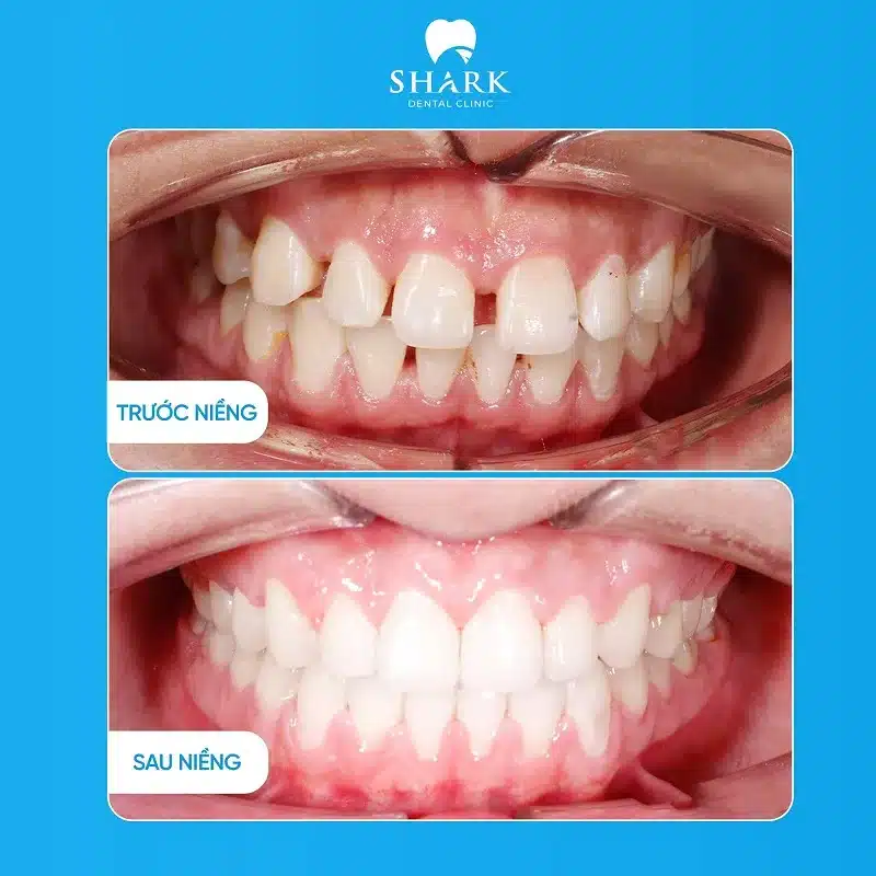 Góc nhìn từ mặt trong răng và nụ cười tự nhiên bên ngoài