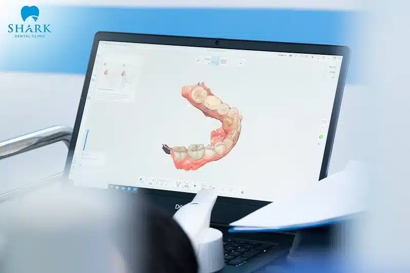 Quy trình niềng răng gồm các giai đoạn nào? Có mấy bước? 16 Kế hoạch điều trị 3D