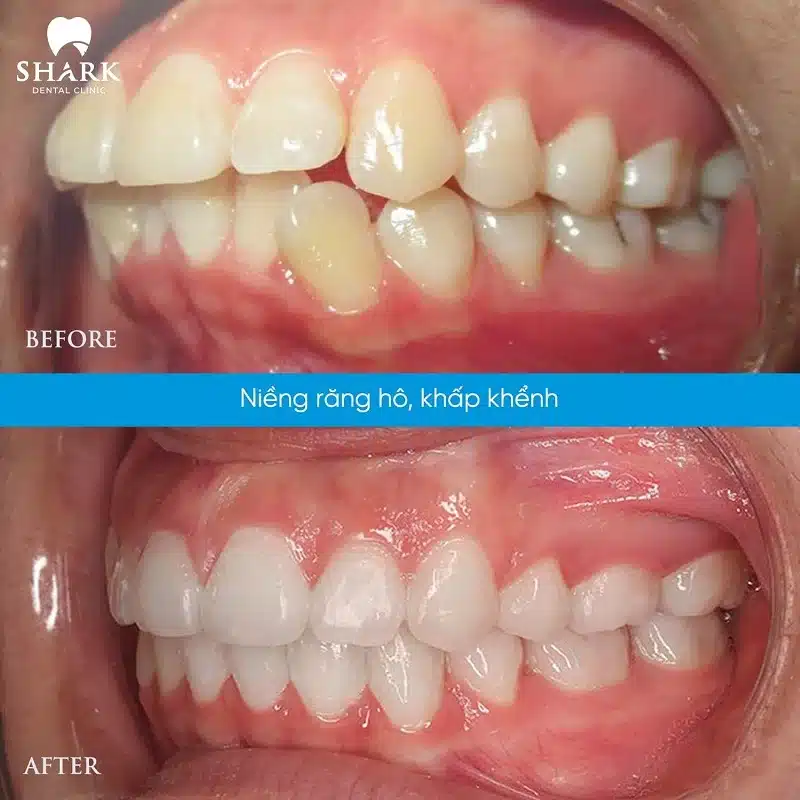 Niềng răng trong suốt là gì? Có thật sự hiệu quả không? 26 Niềng răng không mắc cài điều trị răng hô