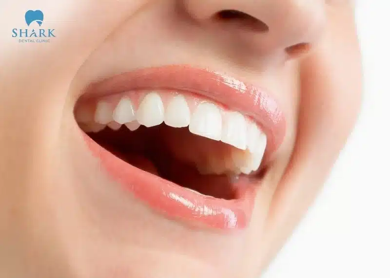 Phân độ cao răng ở mức độ 1 là giai đoạn nhẹ nhất, mới hình thành và thường khó nhận biết bằng mắt thường