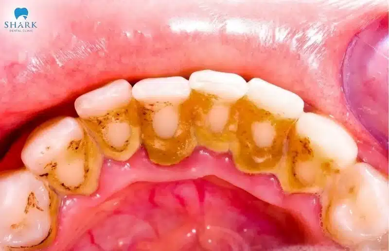 Phân độ cao răng ở mức độ 3 có thể dễ dàng nhận thấy bằng mắt thường nhờ màu sắc đậm, xỉn và kém thẩm mỹ